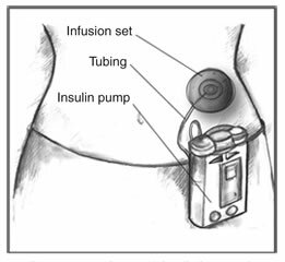 Insulinpump